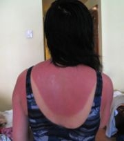 Sunburn